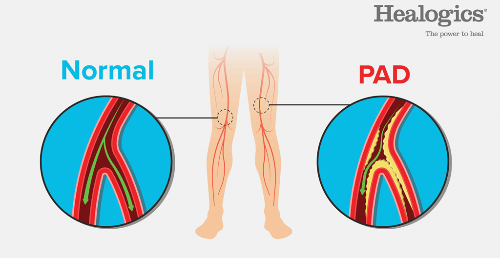 Illustration showing difference between a normal artery and an artery from a person who has PAD